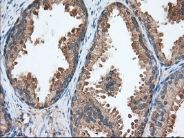 IHC-P analysis of human prostate tissue using GTX83533 TACC3 antibody [7B11]. Antigen retrieval : Heat-induced epitope retrieval by 10mM citrate buffer, pH6.0, 100oC for 10min. Dilution : 1:50
