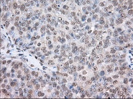 IHC-P analysis of human ovary adenocarcinoma tissue using GTX83534 TACC3 antibody [8F6]. Antigen retrieval : Heat-induced epitope retrieval by 10mM citrate buffer, pH6.0, 100oC for 10min. Dilution : 1:50