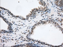 IHC-P analysis of human prostate carcinoma tissue using GTX83534 TACC3 antibody [8F6]. Antigen retrieval : Heat-induced epitope retrieval by 10mM citrate buffer, pH6.0, 100oC for 10min. Dilution : 1:50