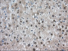 IHC-P analysis of human liver tissue using GTX83534 TACC3 antibody [8F6]. Antigen retrieval : Heat-induced epitope retrieval by 10mM citrate buffer, pH6.0, 100oC for 10min. Dilution : 1:50