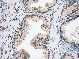 IHC-P analysis of human prostate tissue using GTX83534 TACC3 antibody [8F6]. Antigen retrieval : Heat-induced epitope retrieval by 10mM citrate buffer, pH6.0, 100oC for 10min. Dilution : 1:50