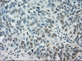 IHC-P analysis of human ovary adenocarcinoma tissue using GTX83541 STK39 antibody [3C12]. Antigen retrieval : Heat-induced epitope retrieval by 10mM citrate buffer, pH6.0, 100oC for 10min.
