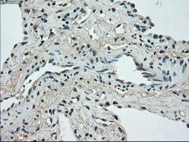 IHC-P analysis of human lung carcinoma tissue using GTX83541 STK39 antibody [3C12]. Antigen retrieval : Heat-induced epitope retrieval by 10mM citrate buffer, pH6.0, 100oC for 10min.