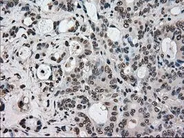 IHC-P analysis of colon adenocarcinoma tissue using GTX83543 STK39 antibody [2E10]. Antigen retrieval : Heat-induced epitope retrieval by 10mM citrate buffer, pH6.0, 100oC for 10min. Dilution : 1:50