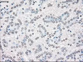 IHC-P analysis of kidney carcinoma tissue using GTX83546 STK3 antibody [4G10]. Antigen retrieval : Heat-induced epitope retrieval by 10mM citrate buffer, pH6.0, 100oC for 10min. Dilution : 1:50