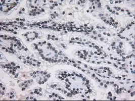IHC-P analysis of kidney carcinoma tissue using GTX83549 STAT3 antibody [21E7]. Antigen retrieval : Heat-induced epitope retrieval by 10mM citrate buffer, pH6.0, 100oC for 10min. Dilution : 1:150