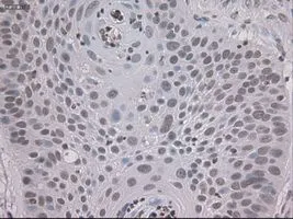 IHC-P analysis of lung carcinoma tissue using GTX83549 STAT3 antibody [21E7]. Antigen retrieval : Heat-induced epitope retrieval by 10mM citrate buffer, pH6.0, 100oC for 10min. Dilution : 1:150