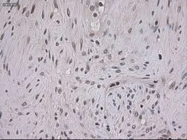 IHC-P analysis of pancreas carcinoma tissue using GTX83549 STAT3 antibody [21E7]. Antigen retrieval : Heat-induced epitope retrieval by 10mM citrate buffer, pH6.0, 100oC for 10min. Dilution : 1:150