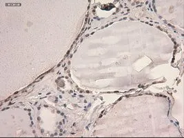 IHC-P analysis of thyroid tissue using GTX83549 STAT3 antibody [21E7]. Antigen retrieval : Heat-induced epitope retrieval by 10mM citrate buffer, pH6.0, 100oC for 10min. Dilution : 1:150