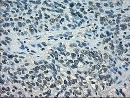 IHC-P analysis of bladder carcinoma tissue using GTX83550 STAT1 antibody [15H3]. Antigen retrieval : Heat-induced epitope retrieval by 10mM citrate buffer, pH6.0, 100oC for 10min. Dilution : 1:50