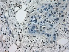 IHC-P analysis of pancreas carcinoma tissue using GTX83550 STAT1 antibody [15H3]. Antigen retrieval : Heat-induced epitope retrieval by 10mM citrate buffer, pH6.0, 100oC for 10min. Dilution : 1:50