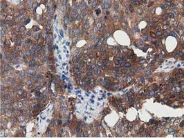 IHC-P analysis of human ovary adenocarcinoma tissue using GTX83556 SSSCA1 antibody [2F5].