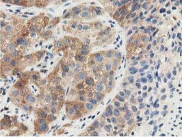 IHC-P analysis of human bladder carcinoma tissue using GTX83556 SSSCA1 antibody [2F5].