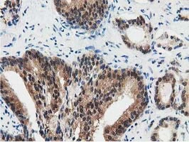 IHC-P analysis of human prostate carcinoma tissue using GTX83556 SSSCA1 antibody [2F5].