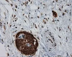 IHC-P analysis of pancreas carcinoma tissue using GTX83645 SIL1 antibody [1F9]. Antigen retrieval : Heat-induced epitope retrieval by 10mM citrate buffer, pH6.0, 100oC for 10min. Dilution : 1:50