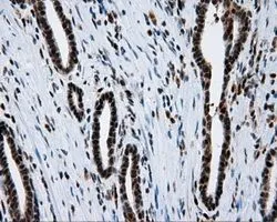 IHC-P analysis of prostate carcinoma tissue using GTX83645 SIL1 antibody [1F9]. Antigen retrieval : Heat-induced epitope retrieval by 10mM citrate buffer, pH6.0, 100oC for 10min. Dilution : 1:50