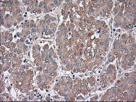 IHC-P analysis of human liver carcinoma tissue using GTX83647 SIGLEC9 antibody [8F7]. Antigen retrieval : Heat-induced epitope retrieval by 10mM citrate buffer, pH6.0, 100oC for 10min.