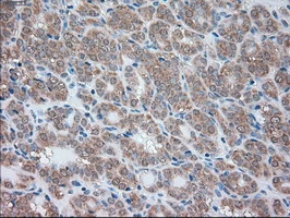 IHC-P analysis of human thyroid carcinoma tissue using GTX83647 SIGLEC9 antibody [8F7]. Antigen retrieval : Heat-induced epitope retrieval by 10mM citrate buffer, pH6.0, 100oC for 10min.