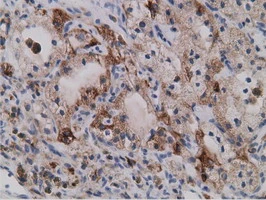 IHC-P analysis of human kidney carcinoma tissue using GTX83671 SDR9C7 antibody [4B5]. Antigen retrieval : Heat-induced epitope retrieval by 10mM citrate buffer, pH6.0, 100oC for 10min.