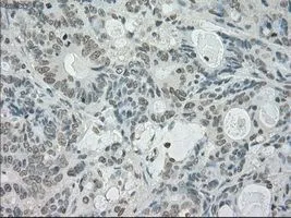 IHC-P analysis of colon adenocarcinoma tissue using GTX83682 SATB1 antibody [13D6]. Antigen retrieval : Heat-induced epitope retrieval by 10mM citrate buffer, pH6.0, 100oC for 10min. Dilution : 1:50