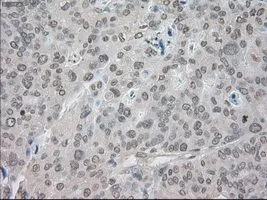 IHC-P analysis of endometrium adenocarcinoma tissue using GTX83682 SATB1 antibody [13D6]. Antigen retrieval : Heat-induced epitope retrieval by 10mM citrate buffer, pH6.0, 100oC for 10min. Dilution : 1:50