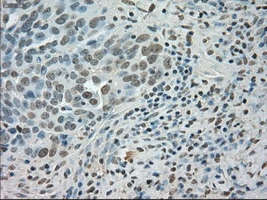 IHC-P analysis of human ovary adenocarcinoma tissue using GTX83682 SATB1 antibody [13D6]. Antigen retrieval : Heat-induced epitope retrieval by 10mM citrate buffer, pH6.0, 100oC for 10min. Dilution : 1:50
