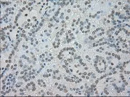 IHC-P analysis of kidney carcinoma tissue using GTX83682 SATB1 antibody [13D6]. Antigen retrieval : Heat-induced epitope retrieval by 10mM citrate buffer, pH6.0, 100oC for 10min. Dilution : 1:50