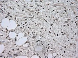 IHC-P analysis of pancreas carcinoma tissue using GTX83682 SATB1 antibody [13D6]. Antigen retrieval : Heat-induced epitope retrieval by 10mM citrate buffer, pH6.0, 100oC for 10min. Dilution : 1:50