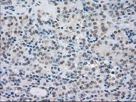 IHC-P analysis of thyroid carcinoma tissue using GTX83682 SATB1 antibody [13D6]. Antigen retrieval : Heat-induced epitope retrieval by 10mM citrate buffer, pH6.0, 100oC for 10min. Dilution : 1:50