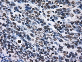 IHC-P analysis of human ovary adenocarcinoma tissue using GTX83688 RPA32 antibody [8B3]. Antigen retrieval : Heat-induced epitope retrieval by 10mM citrate buffer, pH6.0, 100oC for 10min.