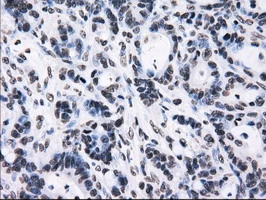 IHC-P analysis of human colon adenocarcinoma tissue using GTX83695 RPA32 antibody [7C12]. Antigen retrieval : Heat-induced epitope retrieval by 10mM citrate buffer, pH6.0, 100oC for 10min.