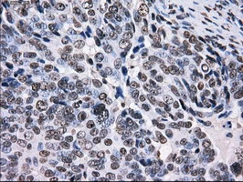 IHC-P analysis of human ovary adenocarcinoma tissue using GTX83695 RPA32 antibody [7C12]. Antigen retrieval : Heat-induced epitope retrieval by 10mM citrate buffer, pH6.0, 100oC for 10min.