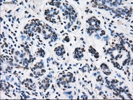 IHC-P analysis of human breast tissue using GTX83695 RPA32 antibody [7C12]. Antigen retrieval : Heat-induced epitope retrieval by 10mM citrate buffer, pH6.0, 100oC for 10min.