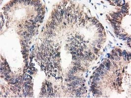 IHC-P analysis of human endometrium adenocarcinoma tissue using GTX83696 Ribonuclease Inhibitor antibody [3F11].