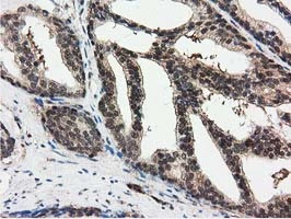 IHC-P analysis of human prostate carcinoma tissue using GTX83696 Ribonuclease Inhibitor antibody [3F11].