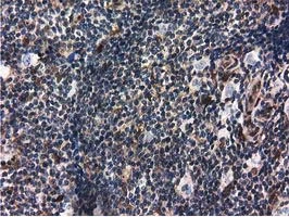 IHC-P analysis of human lymphoma tissue using GTX83696 Ribonuclease Inhibitor antibody [3F11].