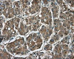 IHC-P analysis of liver carcinoma tissue using GTX83716 RDH11 antibody [1B4]. Antigen retrieval : Heat-induced epitope retrieval by 10mM citrate buffer, pH6.0, 100oC for 10min. Dilution : 1:50