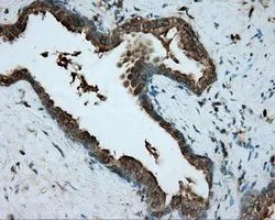 IHC-P analysis of prostate carcinoma tissue using GTX83716 RDH11 antibody [1B4]. Antigen retrieval : Heat-induced epitope retrieval by 10mM citrate buffer, pH6.0, 100oC for 10min. Dilution : 1:50