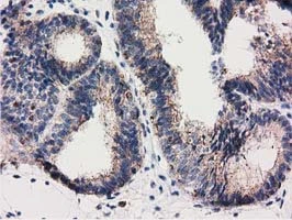 IHC-P analysis of human endometrium adenocarcinoma tissue using GTX83722 RASD2 antibody [1G1].