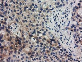 IHC-P analysis of human bladder carcinoma tissue using GTX83722 RASD2 antibody [1G1].