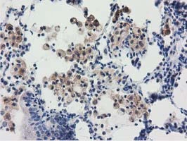 IHC-P analysis of human lung carcinoma tissue using GTX83722 RASD2 antibody [1G1].