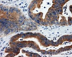 IHC-P analysis of colon adenocarcinoma tissue using GTX83734 RALBP1 antibody [2A6]. Antigen retrieval : Heat-induced epitope retrieval by 10mM citrate buffer, pH6.0, 100oC for 10min. Dilution : 1:50