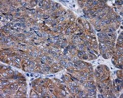 IHC-P analysis of endometrium adenocarcinoma tissue using GTX83734 RALBP1 antibody [2A6]. Antigen retrieval : Heat-induced epitope retrieval by 10mM citrate buffer, pH6.0, 100oC for 10min. Dilution : 1:50