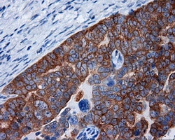 IHC-P analysis of human ovary adenocarcinoma tissue using GTX83734 RALBP1 antibody [2A6]. Antigen retrieval : Heat-induced epitope retrieval by 10mM citrate buffer, pH6.0, 100oC for 10min. Dilution : 1:50