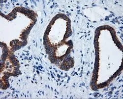 IHC-P analysis of prostate carcinoma tissue using GTX83734 RALBP1 antibody [2A6]. Antigen retrieval : Heat-induced epitope retrieval by 10mM citrate buffer, pH6.0, 100oC for 10min. Dilution : 1:50