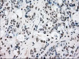 IHC-P analysis of colon adenocarcinoma tissue using GTX83736 RAD9A antibody [7B11]. Antigen retrieval : Heat-induced epitope retrieval by 10mM citrate buffer, pH6.0, 100oC for 10min. Dilution : 1:50