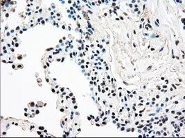 IHC-P analysis of lung carcinoma tissue using GTX83736 RAD9A antibody [7B11]. Antigen retrieval : Heat-induced epitope retrieval by 10mM citrate buffer, pH6.0, 100oC for 10min. Dilution : 1:50
