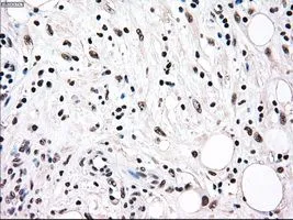 IHC-P analysis of pancreas carcinoma tissue using GTX83736 RAD9A antibody [7B11]. Antigen retrieval : Heat-induced epitope retrieval by 10mM citrate buffer, pH6.0, 100oC for 10min. Dilution : 1:50