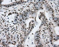 IHC-P analysis of human colon adenocarcinoma tissue using GTX83767 PTPRE antibody [3D4]. Antigen retrieval : Heat-induced epitope retrieval by 1mM EDTA in 10mM Tris buffer (pH8.5) at 120ooC for 3 min.