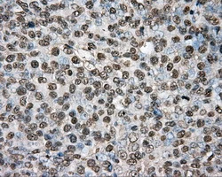 IHC-P analysis of human ovary adenocarcinoma tissue using GTX83767 PTPRE antibody [3D4]. Antigen retrieval : Heat-induced epitope retrieval by 1mM EDTA in 10mM Tris buffer (pH8.5) at 120ooC for 3 min.